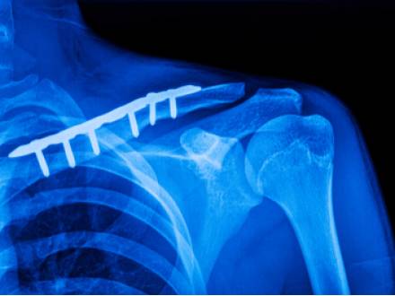 Comal County, TX personal injury lawyer